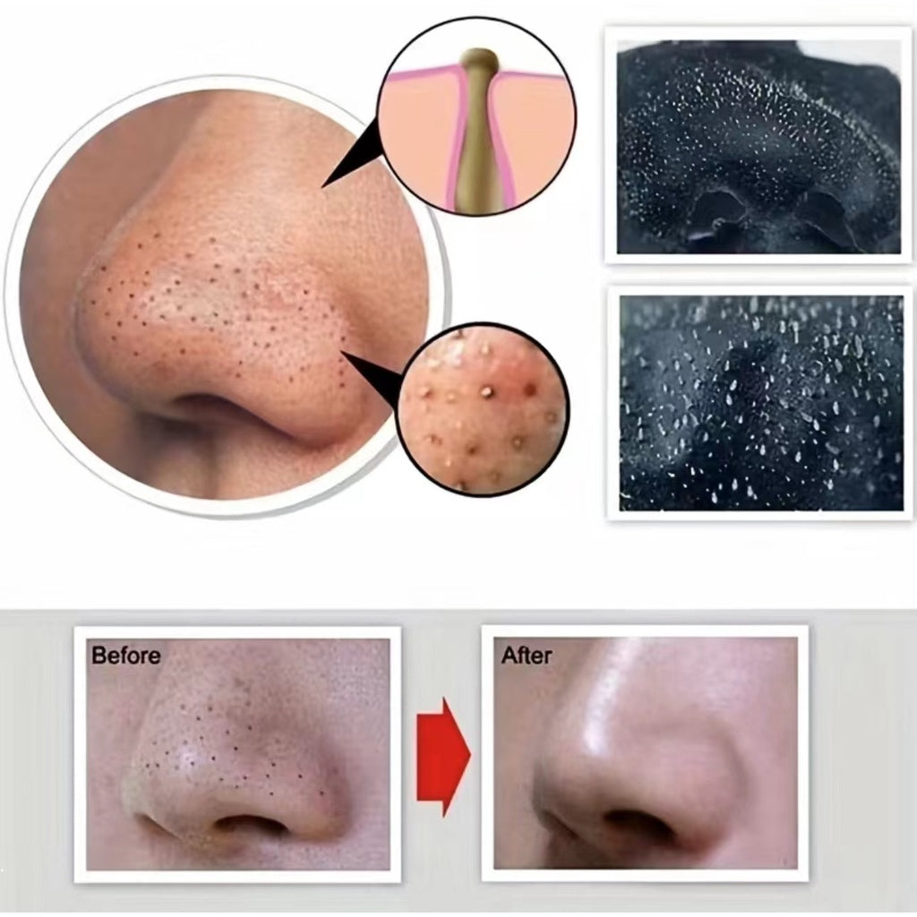 Remove Blackheads and Acne Nasal Membrane Nose Patch Blackhead Nasal Remover, Nose Strips Safe for Home